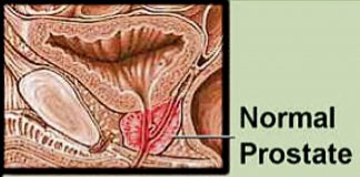 Prostate cancer