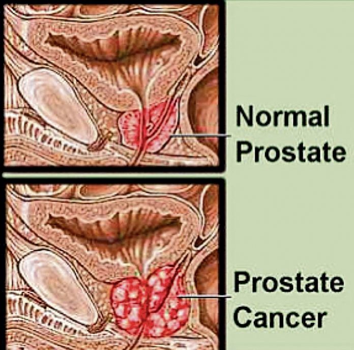 Prostate cancer